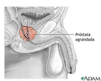 cancer_de_prostata