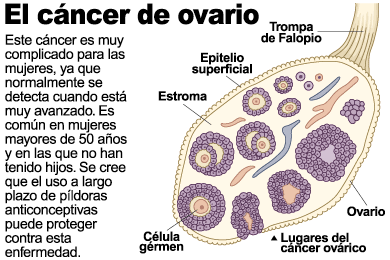 cancer-de-ovario