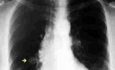nodulo-pulmonar