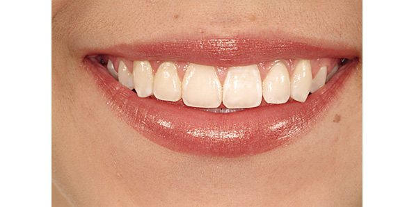 Proporción de los dientes