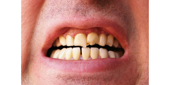 La erosión dental