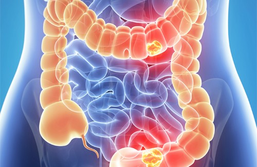 CancerColon1-500x325