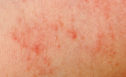 Alergias-en-la-piel
