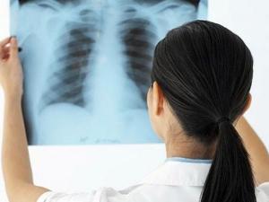 fibrosis-pulmonar-idiopatica-619x348