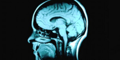 110919100406_epilepsy_schizophrenia_linked_304x171_corbisroyaltyfree