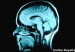 110919100406_epilepsy_schizophrenia_linked_304x171_corbisroyaltyfree