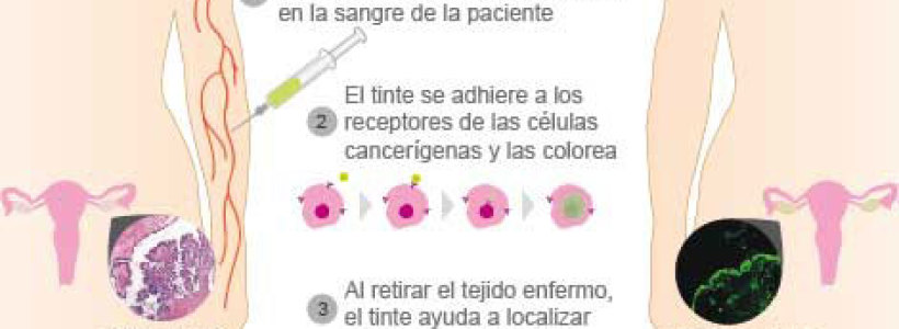 ayuda20fluorecente20contra20cancer
