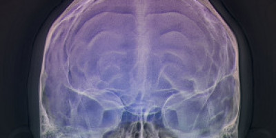 cerebro-brain
