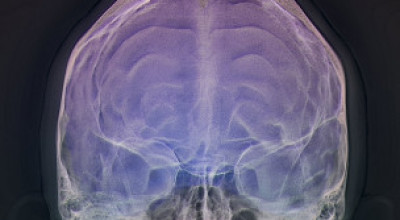 cerebro-brain