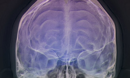 cerebro-brain