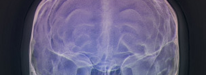 cerebro-brain
