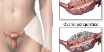 OVARIO1