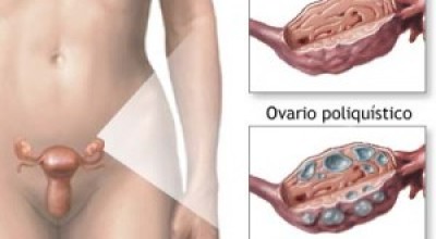 OVARIO1