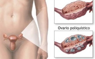OVARIO1