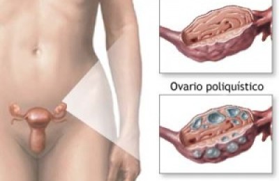 OVARIO1