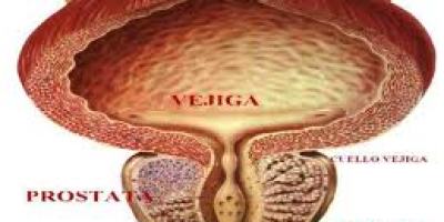 cancer_de_prostata1