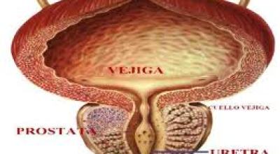 cancer_de_prostata1