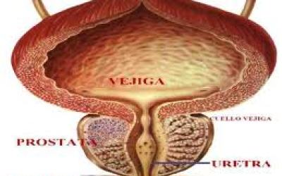 cancer_de_prostata1