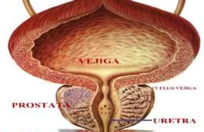 cancer_de_prostata1