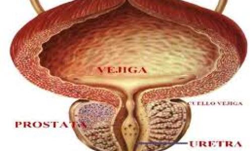 cancer_de_prostata1