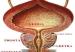 cancer_de_prostata1