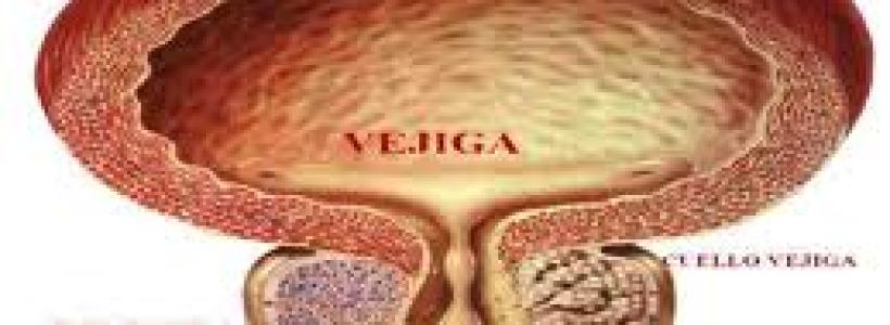 cancer_de_prostata1