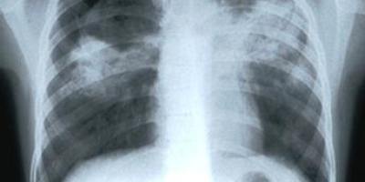 tuberculosis43656