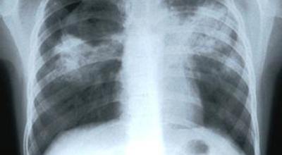 tuberculosis43656