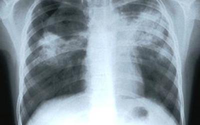tuberculosis43656