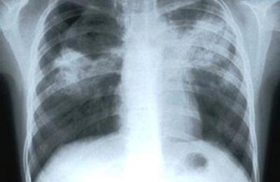 tuberculosis43656