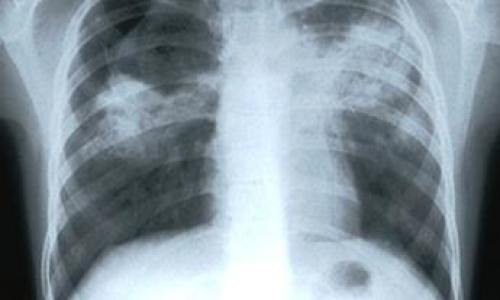 tuberculosis43656