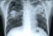 tuberculosis43656