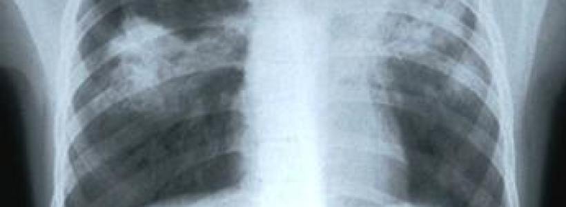 tuberculosis43656
