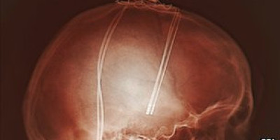Miles_de_pacientes_del_Parkinson_han_experimentado_la_estimulacion_cerebral_profunda