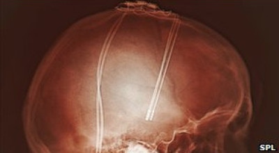 Miles_de_pacientes_del_Parkinson_han_experimentado_la_estimulacion_cerebral_profunda