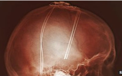 Miles_de_pacientes_del_Parkinson_han_experimentado_la_estimulacion_cerebral_profunda