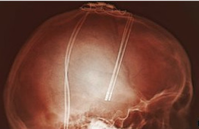 Miles_de_pacientes_del_Parkinson_han_experimentado_la_estimulacion_cerebral_profunda