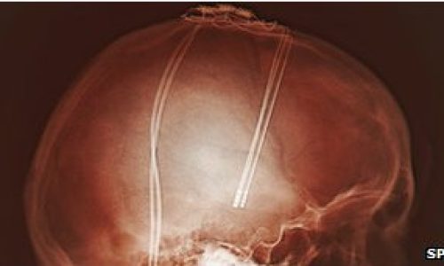 Miles_de_pacientes_del_Parkinson_han_experimentado_la_estimulacion_cerebral_profunda