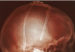 Miles_de_pacientes_del_Parkinson_han_experimentado_la_estimulacion_cerebral_profunda