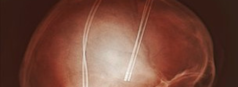 Miles_de_pacientes_del_Parkinson_han_experimentado_la_estimulacion_cerebral_profunda
