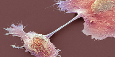 cancer_pancreas