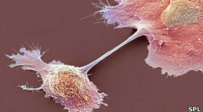 cancer_pancreas