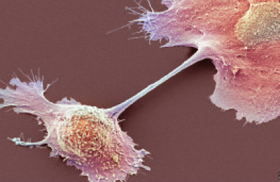 cancer_pancreas
