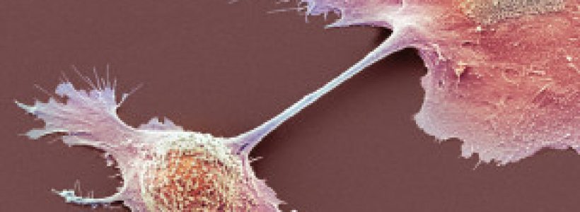 cancer_pancreas
