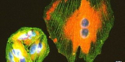 melanoma5637467