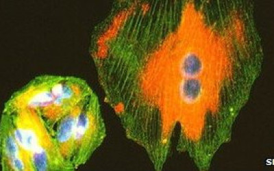 melanoma5637467