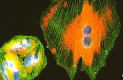 melanoma5637467