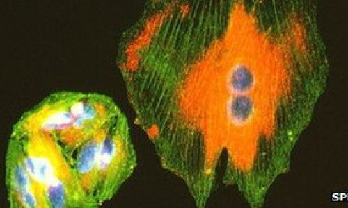 melanoma5637467