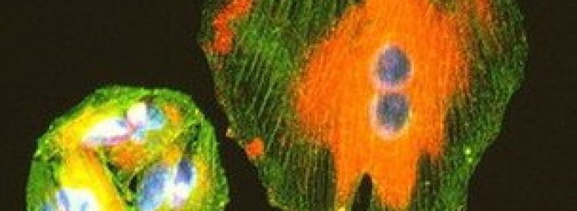 melanoma5637467