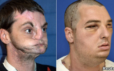 transplante_de_rostro_extraordinario